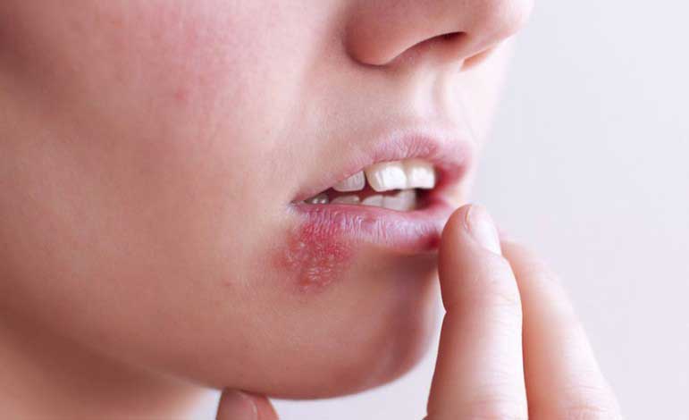 herpes