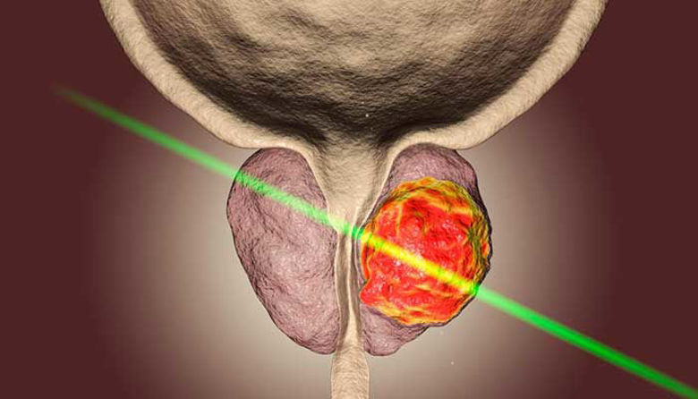 Picture of Fitoterapija benigne hiperplazije prostate