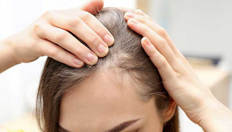 Picture of Alopecija in izpadanje las!