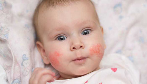 DERMATITIS POD PLENICAMI