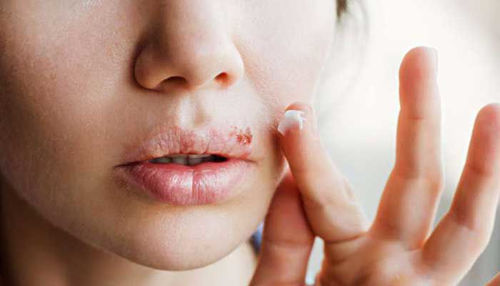 HERPES SIMPLEX