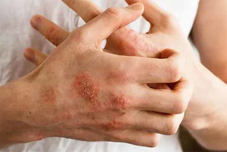Picture of Atopijski dermatitis - Vse o njem in Zavajanje!