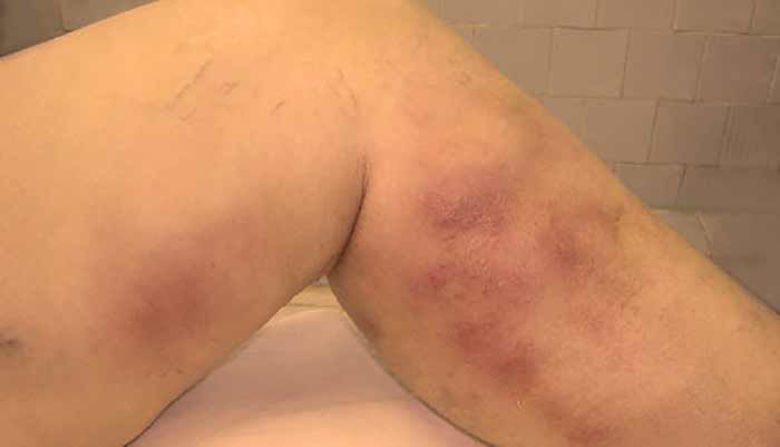 Picture of Flebitis