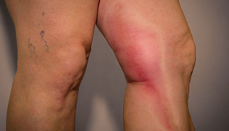 Picture of Tromboflebitis