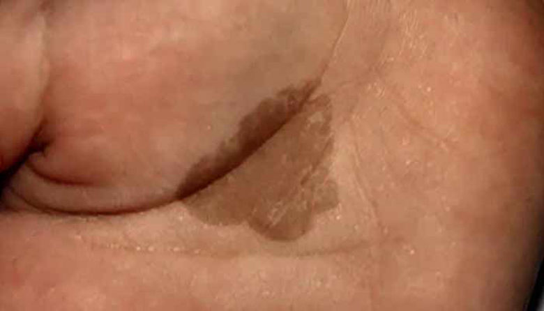 Picture of Kožna plesen (Pityriasis versicolor) - kako jo odstraniti?