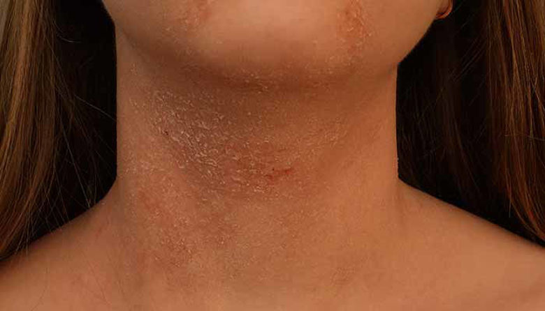 Picture of Atopijski dermatitis slike