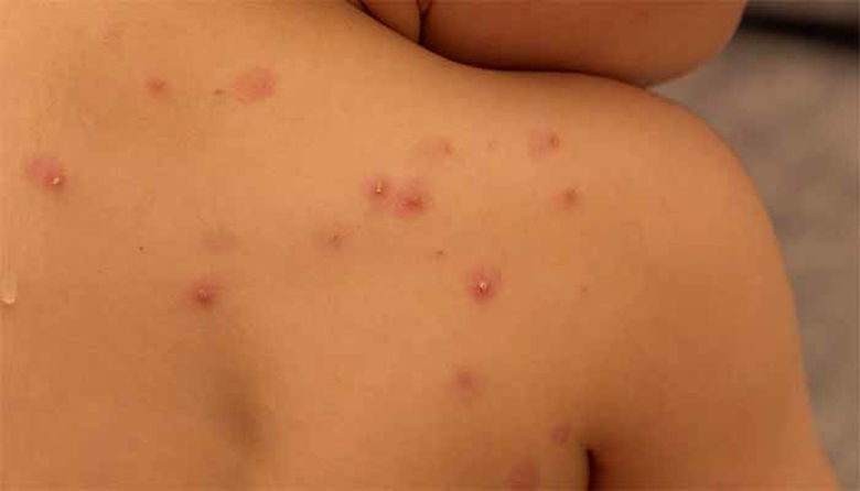 Picture of Vodene koze oz. norice - simptomi, zdravljenje in preventiva