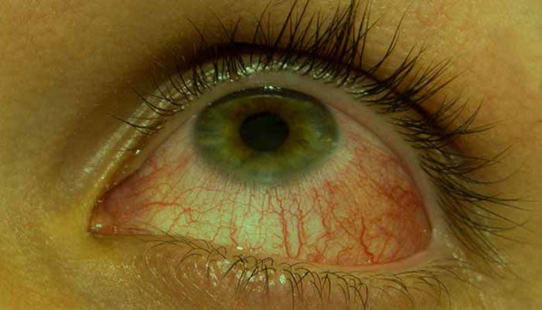 Picture of Konjunktivitis