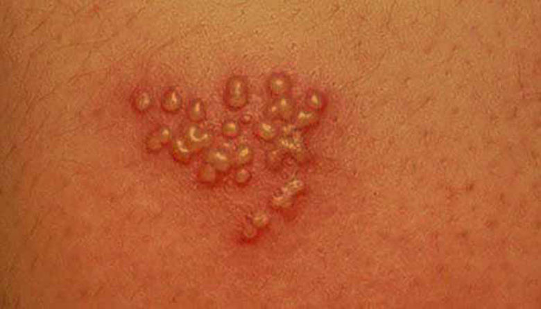 Picture of Genitalni herpes