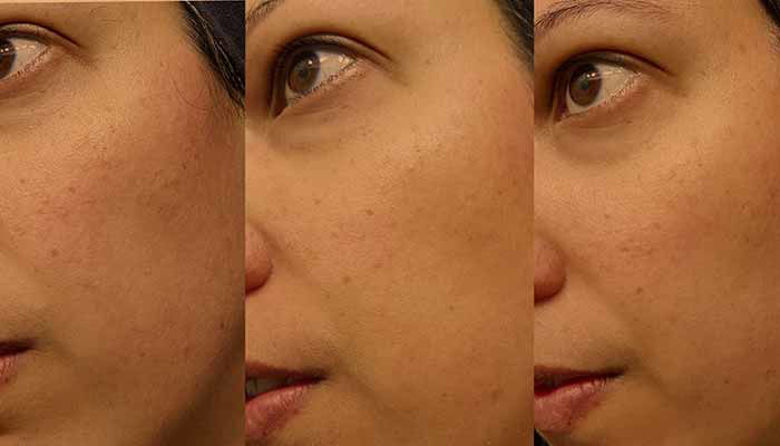 Picture of Tretinoin krema lekarna