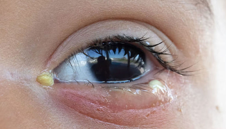 Picture of Bakterijski konjunktivitis