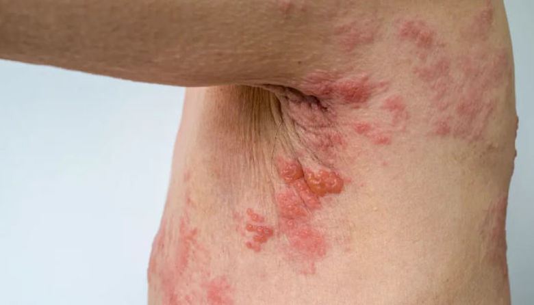 Picture of Herpes zoster posledice